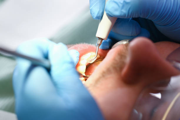 Best Emergency Dentist for Knocked-Out Tooth in Roseville, CA